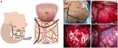 Clinical effect of a modified superficial temporal artery-middle cerebral artery bypass surgery in Moyamoya disease treatment